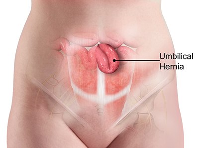 umbilical hernia?